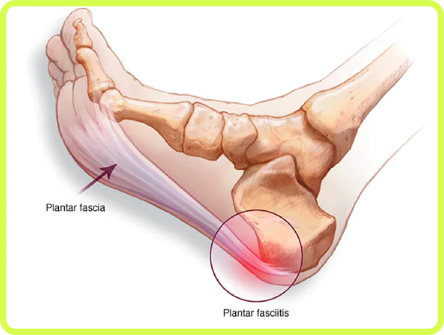 Painful Heels | Heel Bone Pain | Pain In The Heel - Singapore Sports &  Orthopedic Clinic